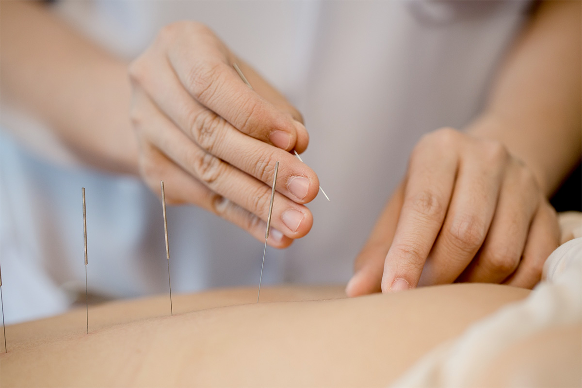 Akupunktur (freepik) Akupunktur
